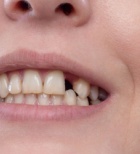 כך תמנעו את נסיגת הלסת: למה חשוב למלא את החלל בין השיניים לאחר עקירה?-תמונה